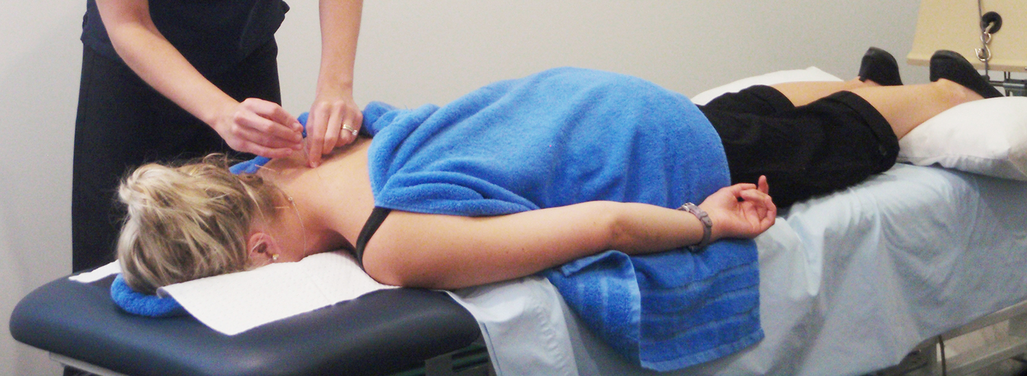 Dry Needling Sapphire Coast Physiotherapy